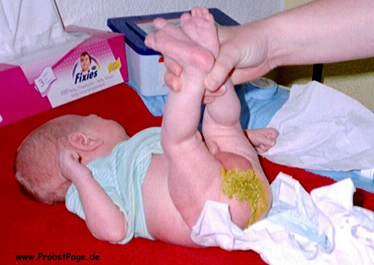Die Hämorrhoide der 2. Stufe die Behandlung